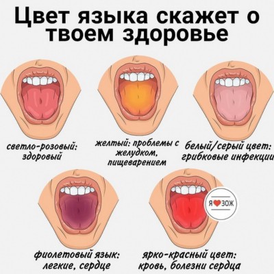 Глоссит языка: симптомы, причины, фото, почему появляются болячки на языке?