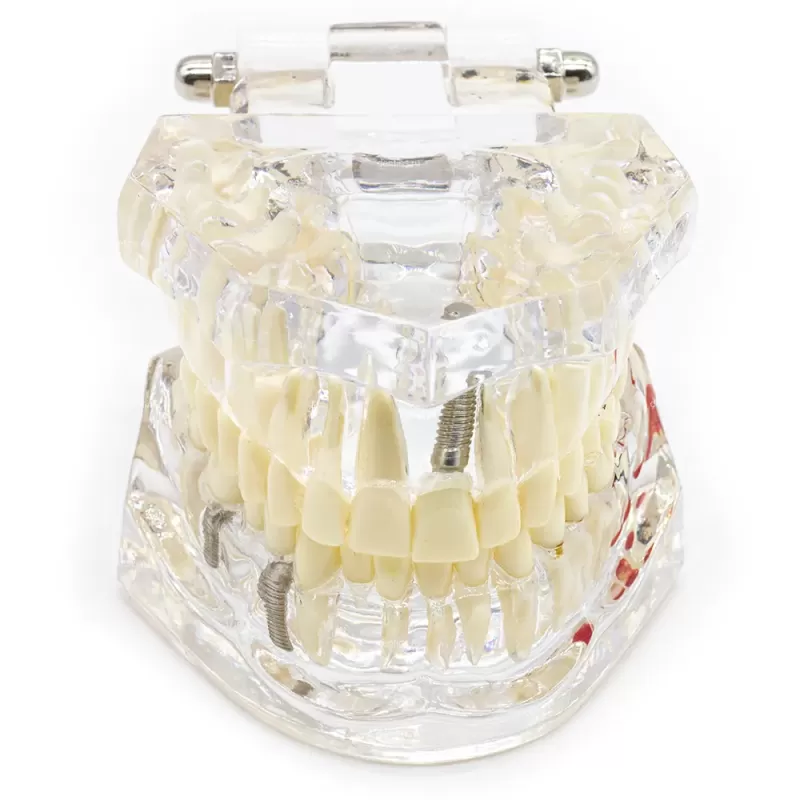 Демонстрационная модель челюсти с зубами прозрачная, патологическая