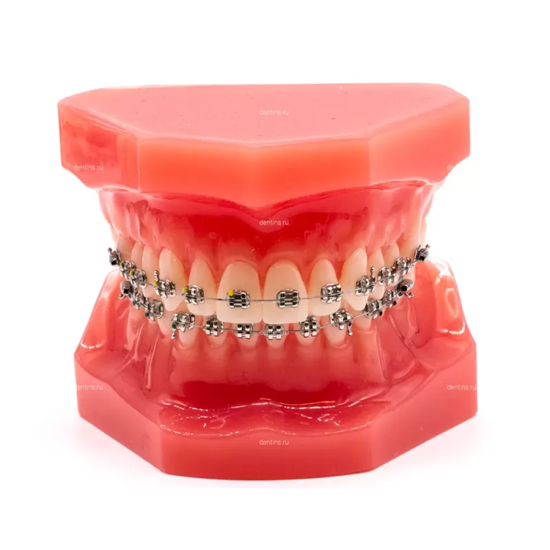 Демонстрационная ортодонтическая модель челюсти с металлическими брекетами