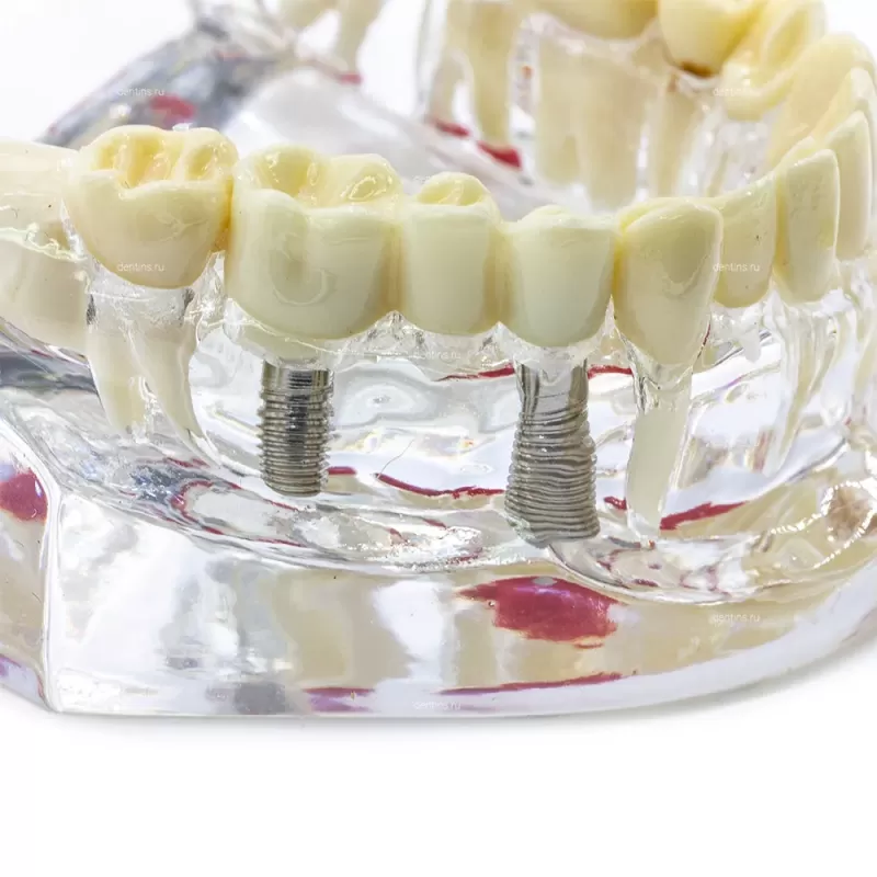 Демонстрационная модель челюсти с зубами прозрачная, патологическая