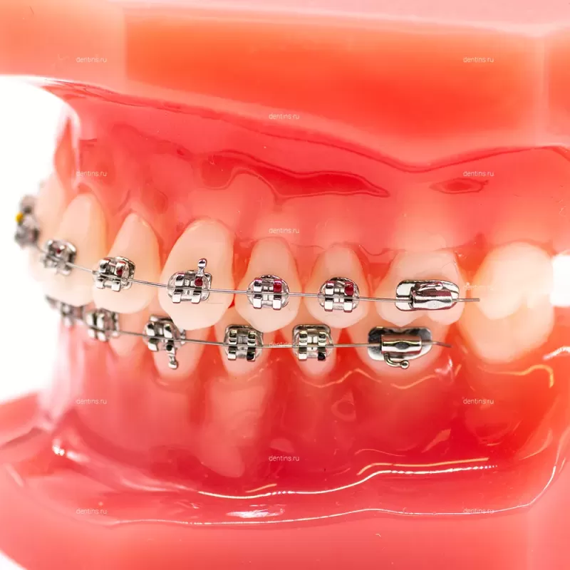 Учебная ортодонтическая модель челюсти с металлическими брекетами