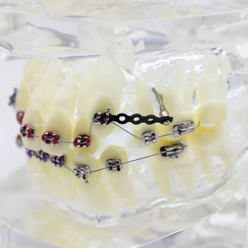 Учебная ортодонтическая модель челюсти с металлическими брекетами, прозрачная