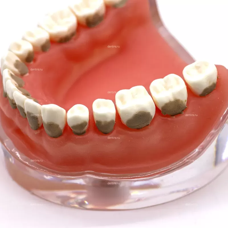 Учебная модель челюсти пародонтологическая, с зубными отложениями