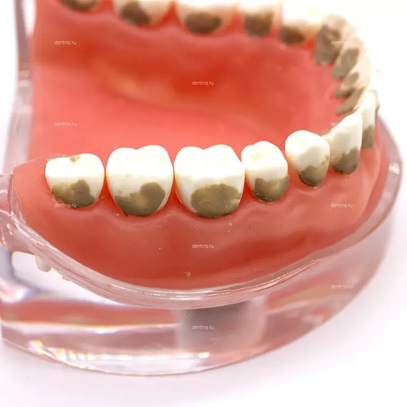 Учебная модель челюсти пародонтологическая, с зубными отложениями