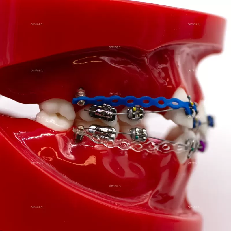 Демонстрационная ортодонтическая модель челюсти, патологическая, красная